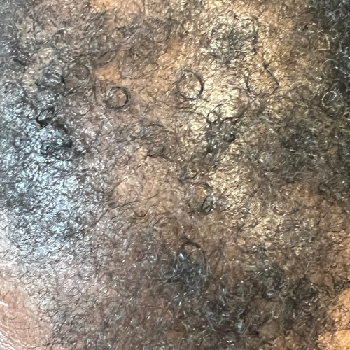 Hair Restoration After