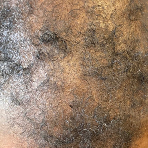 Hair Restoration Before