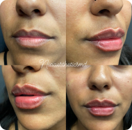 Lip Filler 3