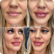 Lip Filler 6