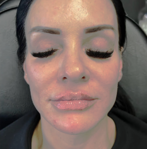 dermal-filler-before-after-01-1-297x30022
